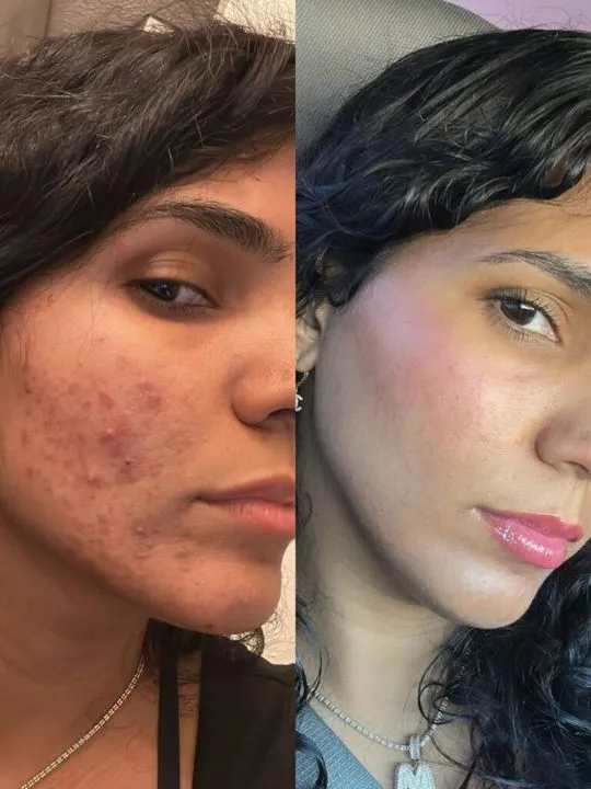 Acne Clear, Client result