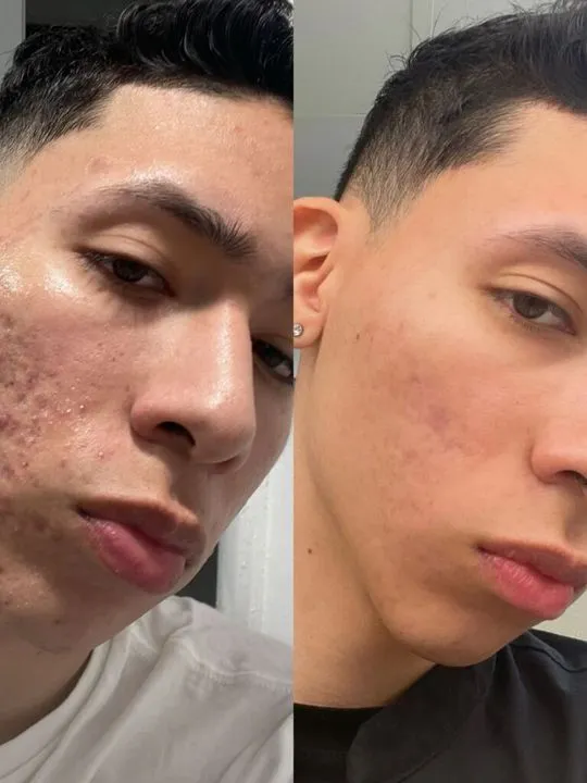 Scar treatment, Client result
