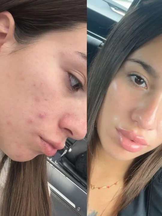 Post-acne, Client result